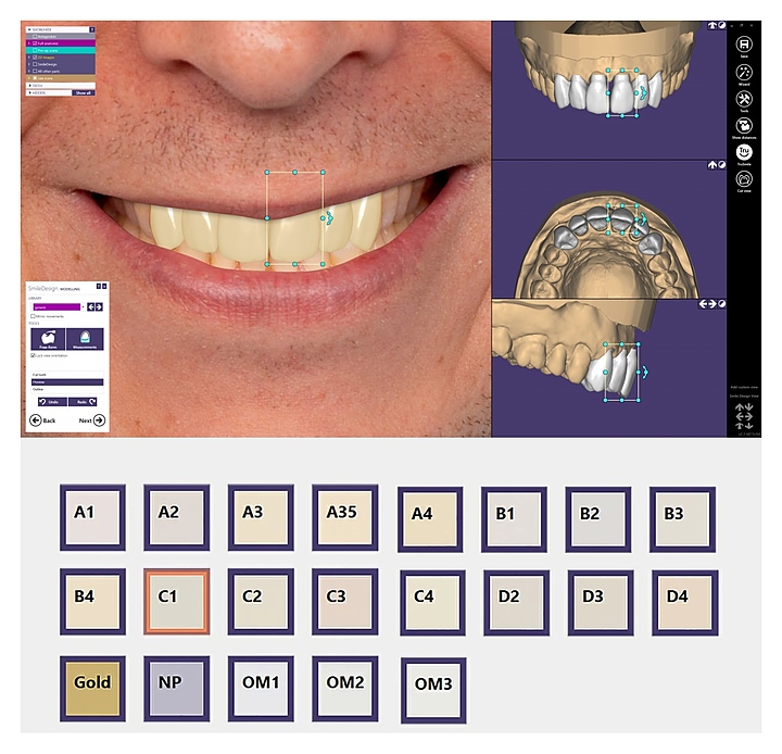 Модуль для программного обеспечения Exocad Smile Creator