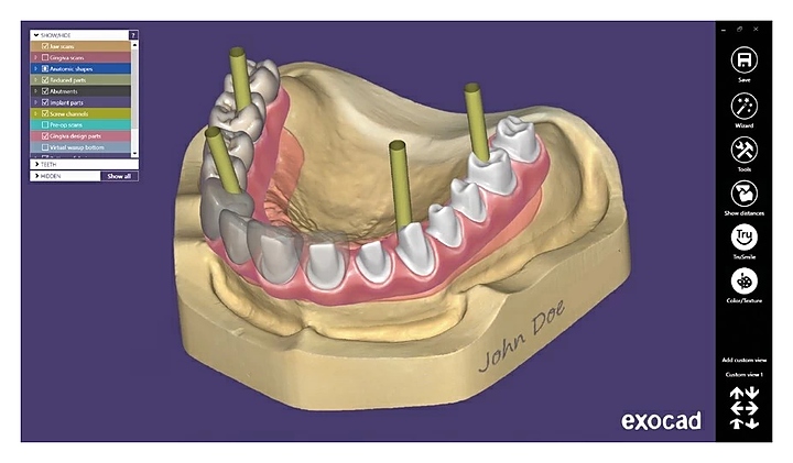 Модуль для программного обеспечения Exocad Implant module