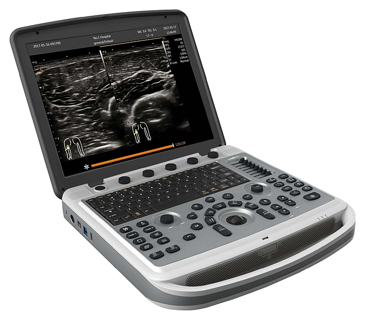 Аппарат УЗИ Chison SonoTouch 80